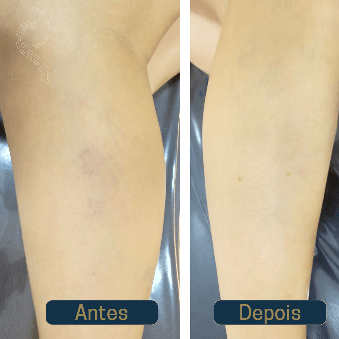 Descubra o tratamento definitivo para varizes e vasinhos, sem cirurgia, sem repouso e sem dor.