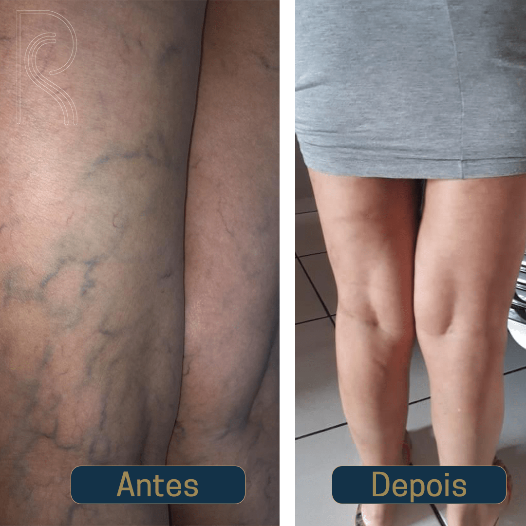 Descubra o tratamento definitivo para varizes e vasinhos, sem cirurgia, sem repouso e sem dor.