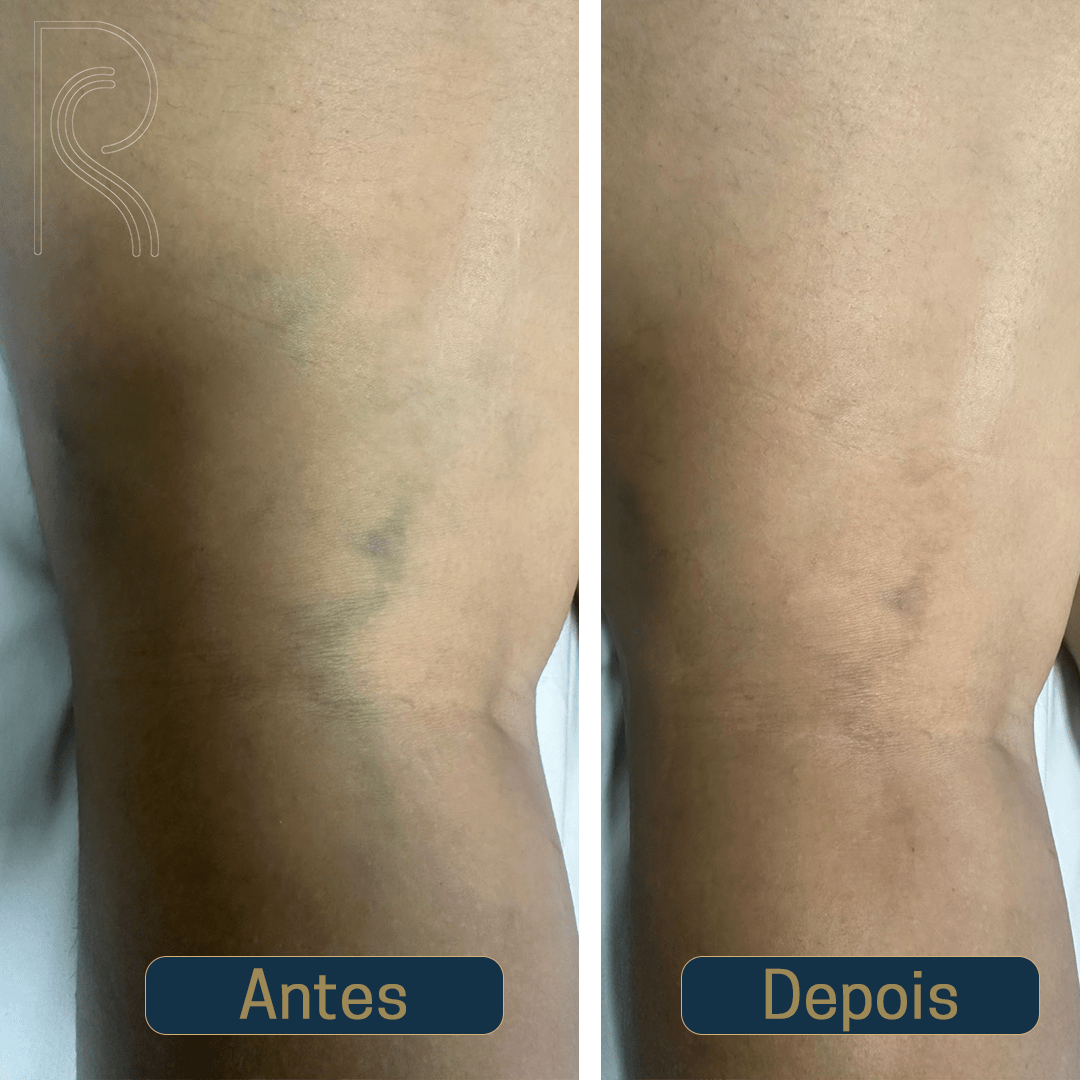 Descubra o tratamento definitivo para varizes e vasinhos, sem cirurgia, sem repouso e sem dor.